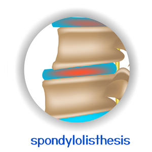 image of Baton Rouge chiropractic spondylolisthesis